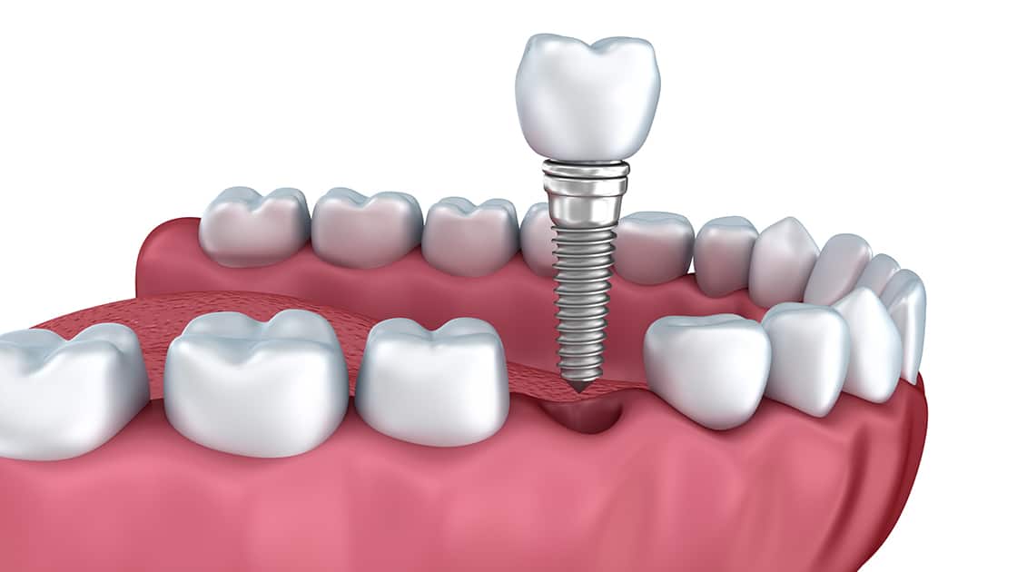 dental implant rendering