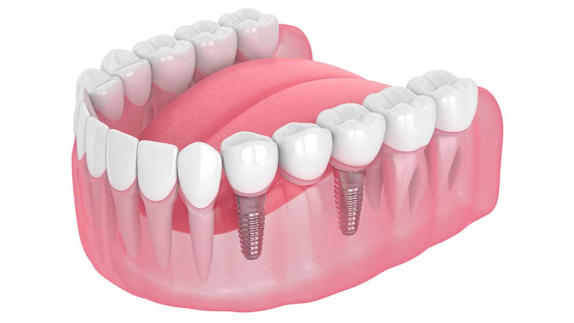 Implant Supported Bridges