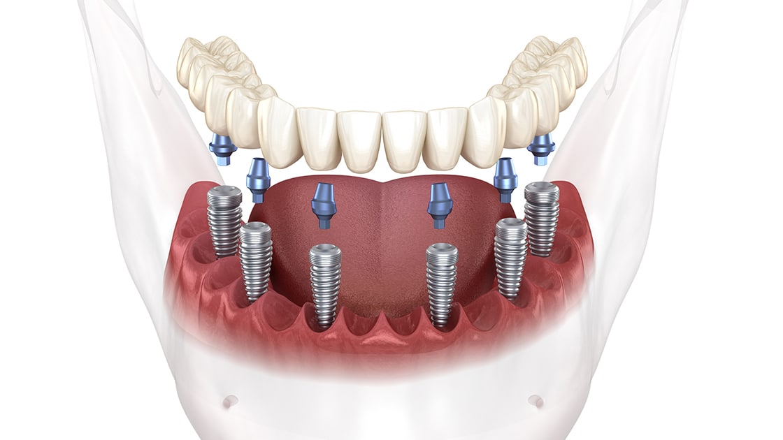Fully Edentulous (Toothless) Solutions