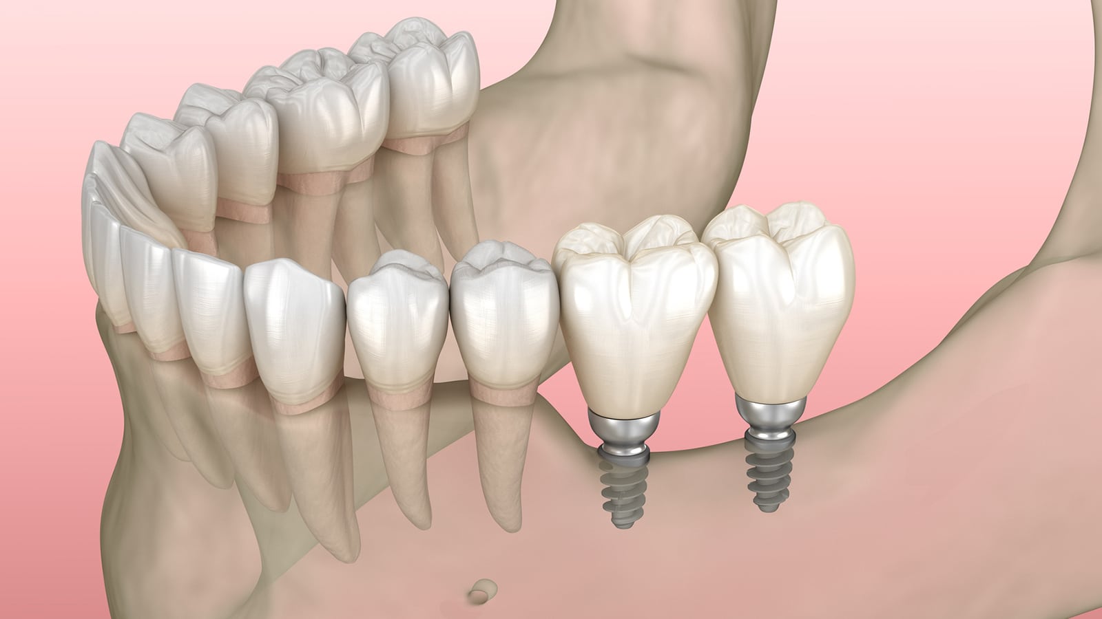 Mini Dental Implants (MDIs)