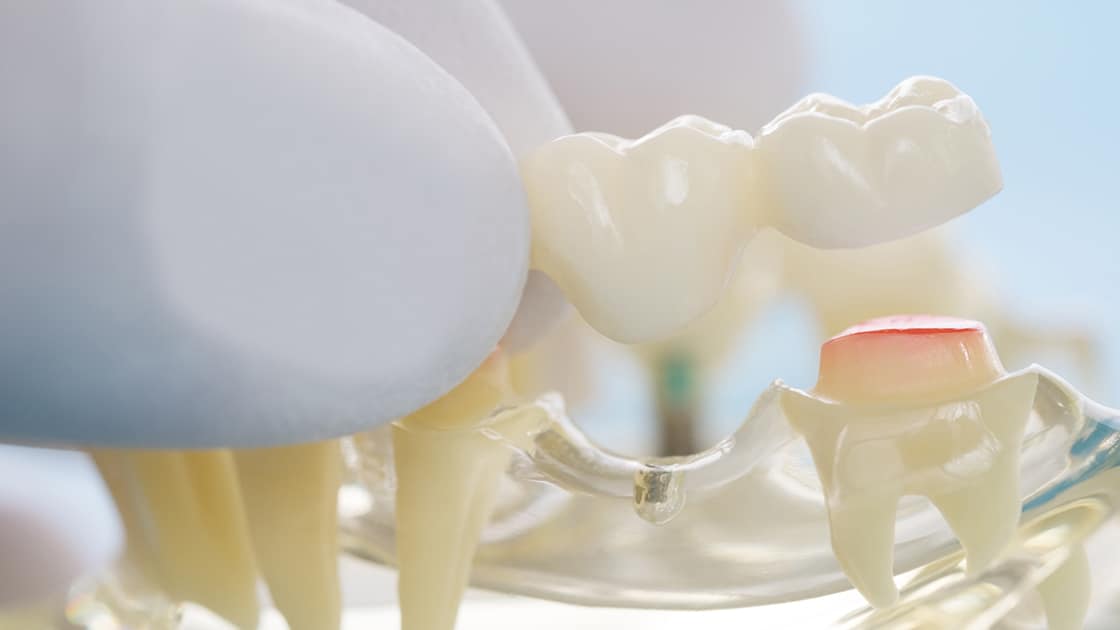 dental bridge being placed on plastic model