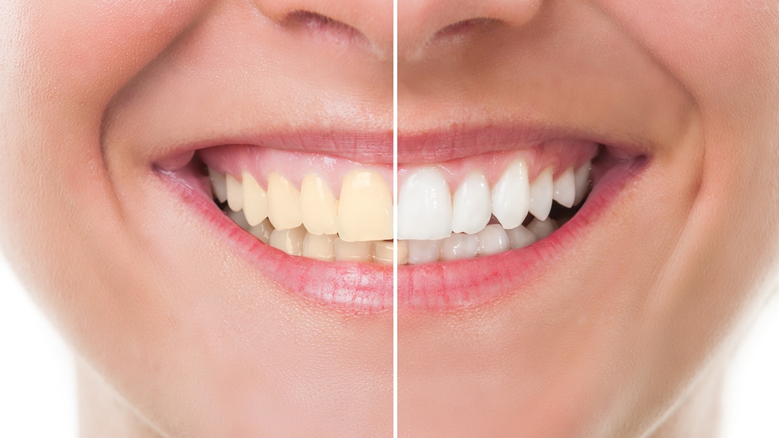 Before and after teeth whitening