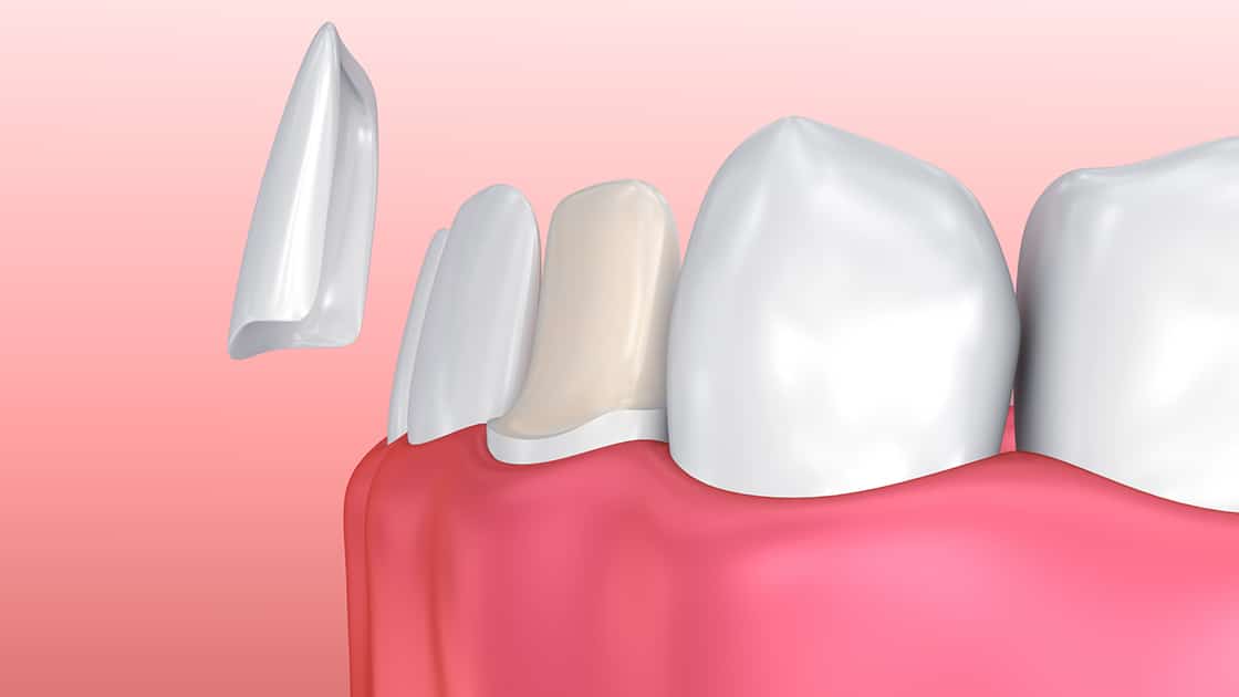 rendering of veneers